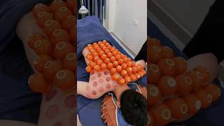 Extreme cupping therapy 🤯shorts cupping therapy [upl. by Eikcaj78]