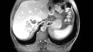 Retroperitoneal Liposarcoma [upl. by Llenel]