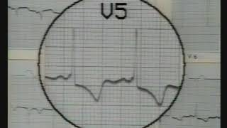 20 WPW Syndrome  ECG Reading  Dr Vaidya [upl. by Mukerji]