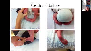 An introduction to the different types of Clubfoot and Metatarsus Adductus [upl. by Yelmene313]