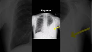 Empyema xray radiology röntgen thorax empyema [upl. by Noman]