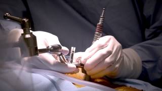 Minimally Invasive Laminectomy Surgery to Treat Lumbar Stenosis  MedStar Southern Maryland [upl. by Zindman]