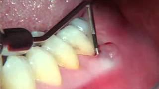 Endodontics Torabinejad 61 Perio of Pulpal Origin [upl. by Nuyh566]