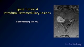 Spine tumors 4 – Intradural Extramedullary Lesions [upl. by Maddalena]