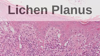 Lichen Planus  Pathology mini tutorial [upl. by Oilerua]