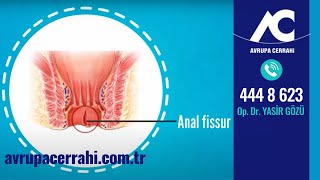 Fissür Makat Çatlağı Tedavisi [upl. by Milicent]