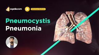 Pneumocystis Pneumonia  Infectious Medicine Lectures  Medical Education  VLearning [upl. by Kyrstin]