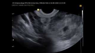 Misdiagnosed ectopic pregnancy mimicking adnexal malignancy a report of two cases [upl. by Meta904]