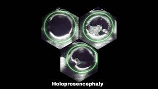 Holoprosencephaly [upl. by Peregrine238]