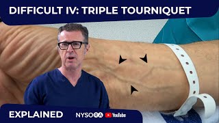 Difficult Intravenous IV cannulation 2 Triple Tourniquet Technique [upl. by Atiugal]