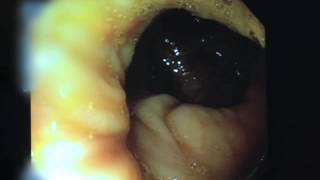 Video of a Colonoscopy [upl. by Namielus]