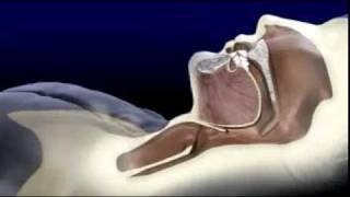 Sleep Apnea Explained By ORA Oral Surgery Sleep Disorder amp Implant Studio [upl. by Zebapda378]