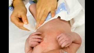 Diaper Rash 1 Symptoms types such as irritant yeast allergic [upl. by Indyc395]