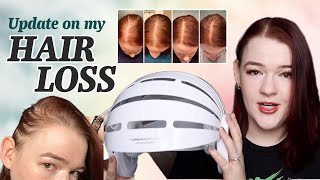 My Hair Loss Experience Update  Rogaine and CurrentBody Skin LED Hair Regrowth Device Review [upl. by Nedda]