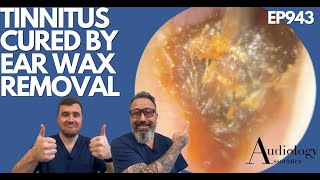 TINNITUS CURED BY EAR WAX REMOVAL  EP943 [upl. by Ursi]