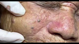 Relax Every Day acne pimplepopping blackheads [upl. by Heller]