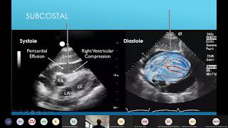 21 04 13 Pericardiocentesis lecture [upl. by Carmena]