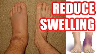 How to Reduce Swelling Make Your Swelling Go Down Easy Methods [upl. by Minor327]