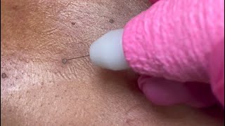 DPN Dermatosis Papulosa Nigra Removal [upl. by Nailluj]