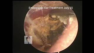 Completely blocked ear cleaning 20230715 [upl. by Krum]