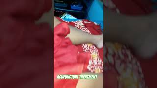 Acupuncture treatment for ulcer [upl. by Aiepoissac332]