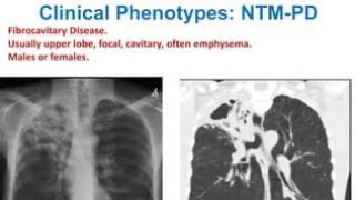 NTM  Non tuberculous mycobacteria [upl. by Akahc573]