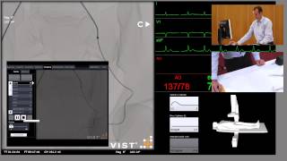 Uterine Artery Angiogram [upl. by Reynard]