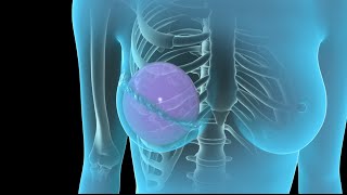 Breast Cancer  Breast Reconstruction  Nucleus Health [upl. by Lauryn74]