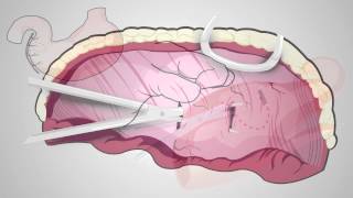 Skills Laboratory How to perform a beltloop gastropexy [upl. by Wilinski]