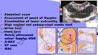 Puerperal sepsis part 2 NGMedicals [upl. by Kuehnel]