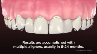 ClearPath Aligners  NEW VIDEO for PATIENT EDUCATION by AACD [upl. by Buine]