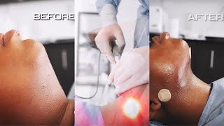 1 YEAR CHIN LIPO UPDATE  MY EXPERIENCE RECOVERY COST ETC [upl. by Yuzik]