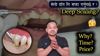 Deep Scaling भनेको के हो  किन जरुरि छ   Scaling price  Teeth cleaning  Scaling amp root planing [upl. by Teufert]