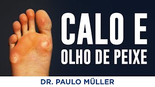 Calo e Olho de Peixe  Dr Paulo Müller Dermatologista [upl. by Flossy896]