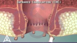 Anal warts amp infrared coagulation treatment  3D animation [upl. by Assillim]