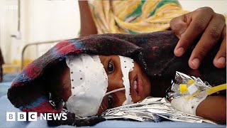 Children losing fight for life in Somalia as catastrophic famine looms  BBC News [upl. by Ilesara728]