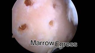 Arthroscopic MicroFracture Trochlear Groove by Chad Smalley MD [upl. by Atinaw]