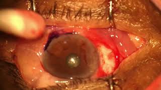 pterygium c grafting [upl. by Drhacir]