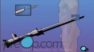 Male Cystoscopy Procedure  PreOp® Patient Education [upl. by Adlaremse345]