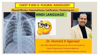 Radiology Chest X Ray 3 HINDI Pleural Effusion pneumothorax ThickeningDr Hemant K Agarwal [upl. by Alaehcim]