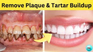 🦷🌿Sparkling Smiles 9 Natural Remedies to Bust Plaque and Tartar 🌟😁 [upl. by Krystle32]