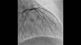 CRUSH TECHNIQUE STENTING OF LAD  D1 BIFURCATION [upl. by Atsedom457]