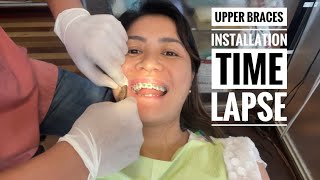 Upper Teeth Braces Installation Time Lapse  Orthodontics TmJ  Class 3  Underbite [upl. by Oicirtap]