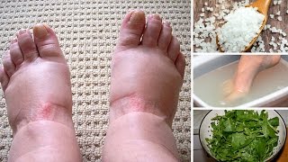 Home Remedies for Swollen Feet [upl. by Dihahs]