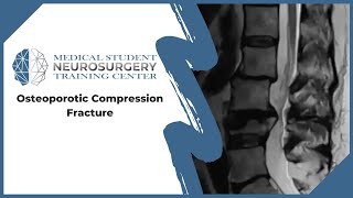 Osteoporotic Compression Fracture [upl. by Meenen]