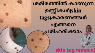 skin tag Malayalamശരീരത്തിൽ കാണുന്ന ഉണ്ണികൾskin tagsകാരണങ്ങൾഎങ്ങനെ പരിഹരിക്കാംSkin tag removal [upl. by Harmonia]