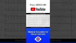 Tachycardiabradycardia syndrome ECG shorts [upl. by Ofelia188]