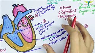 Tetralogy of Fallot TOF [upl. by Boniface541]