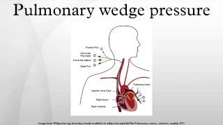 Pulmonary wedge pressure [upl. by Iila]