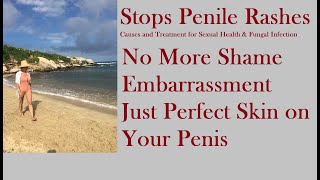 Stops Penile Rashes  Causes and Treatment for Sexual Health amp Fungal Infection [upl. by Htezzil]